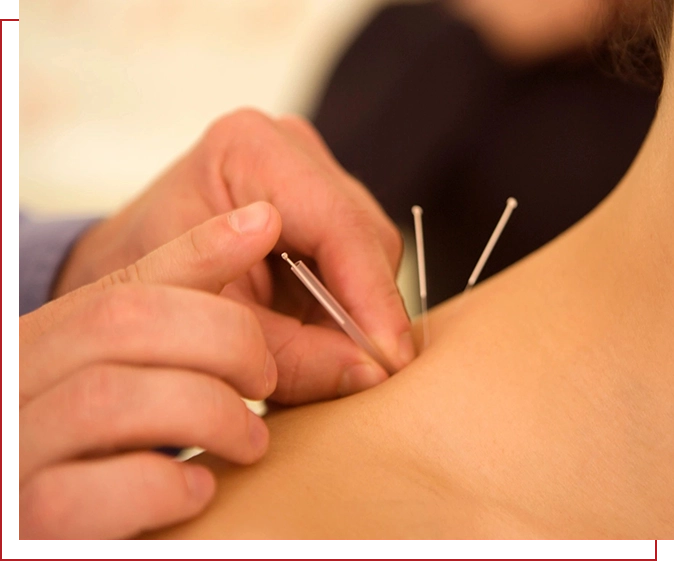 A person is using acupuncture needles on the back of their body.