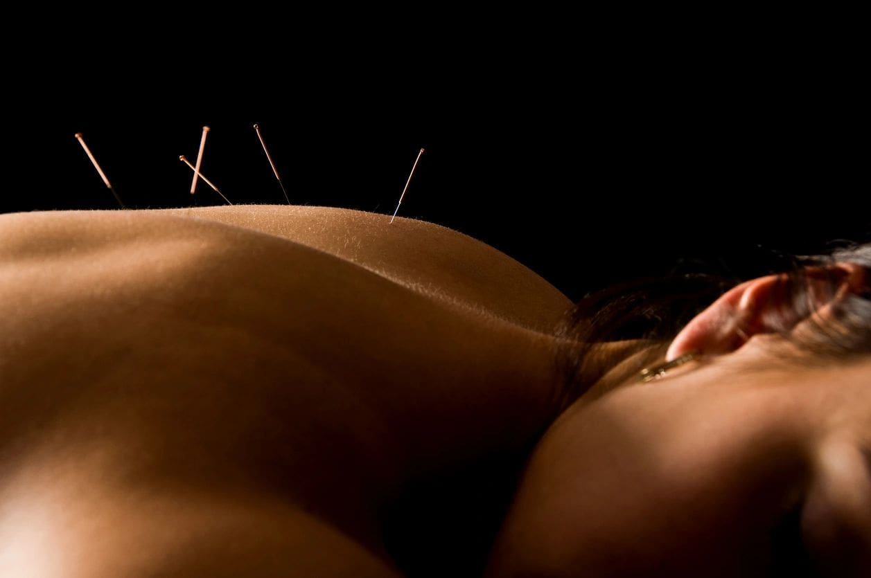 A woman with acupuncture needles in her back.