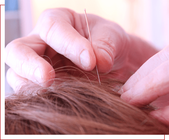 A person is holding onto some needles in their hair.