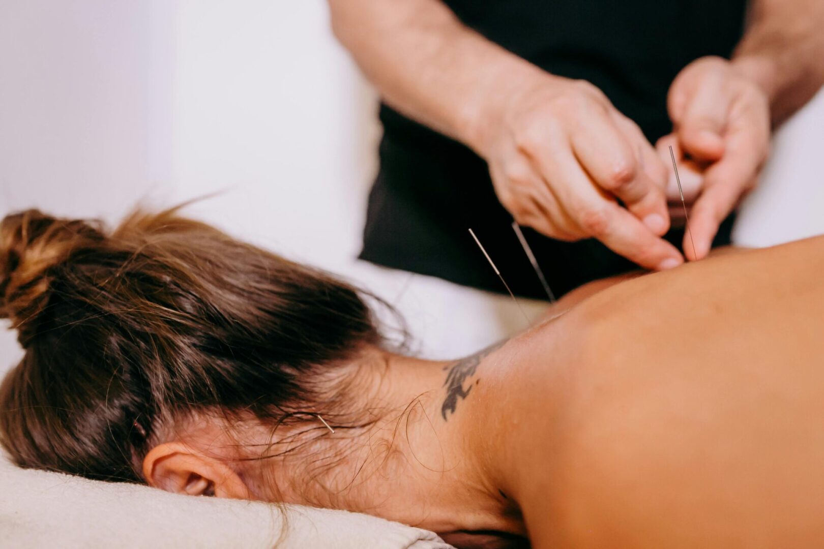 A woman getting acupuncture on her back